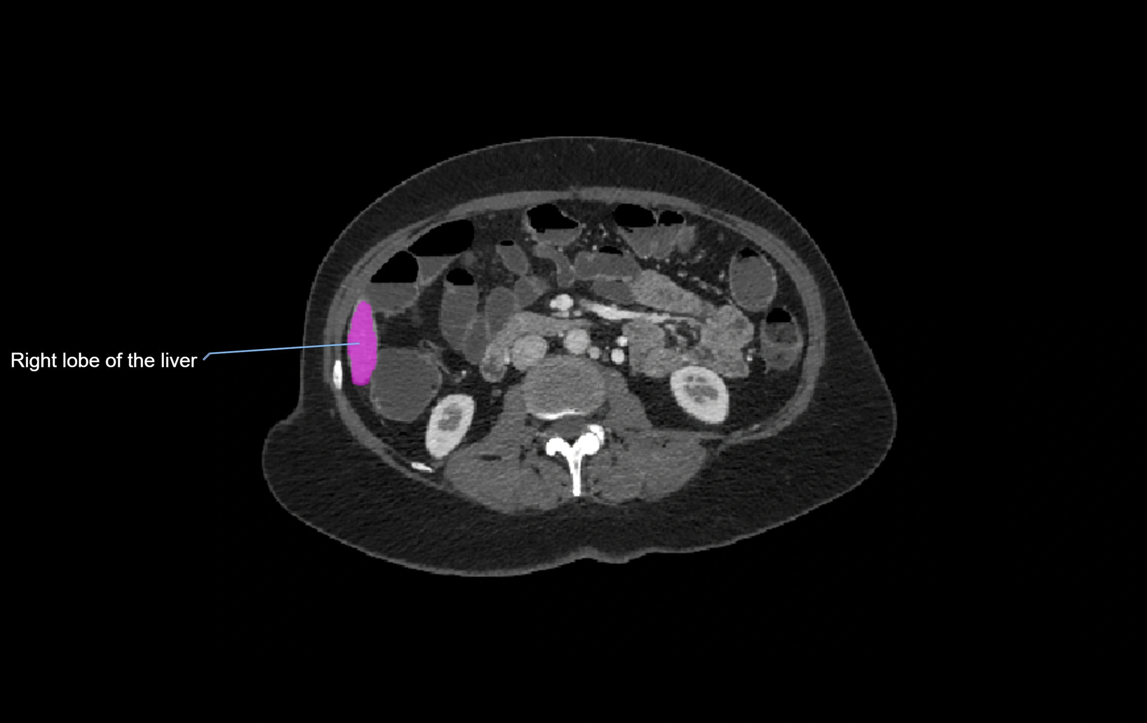 CT lliver lobes axial cross sectional anatomy labelled image -00006.webp